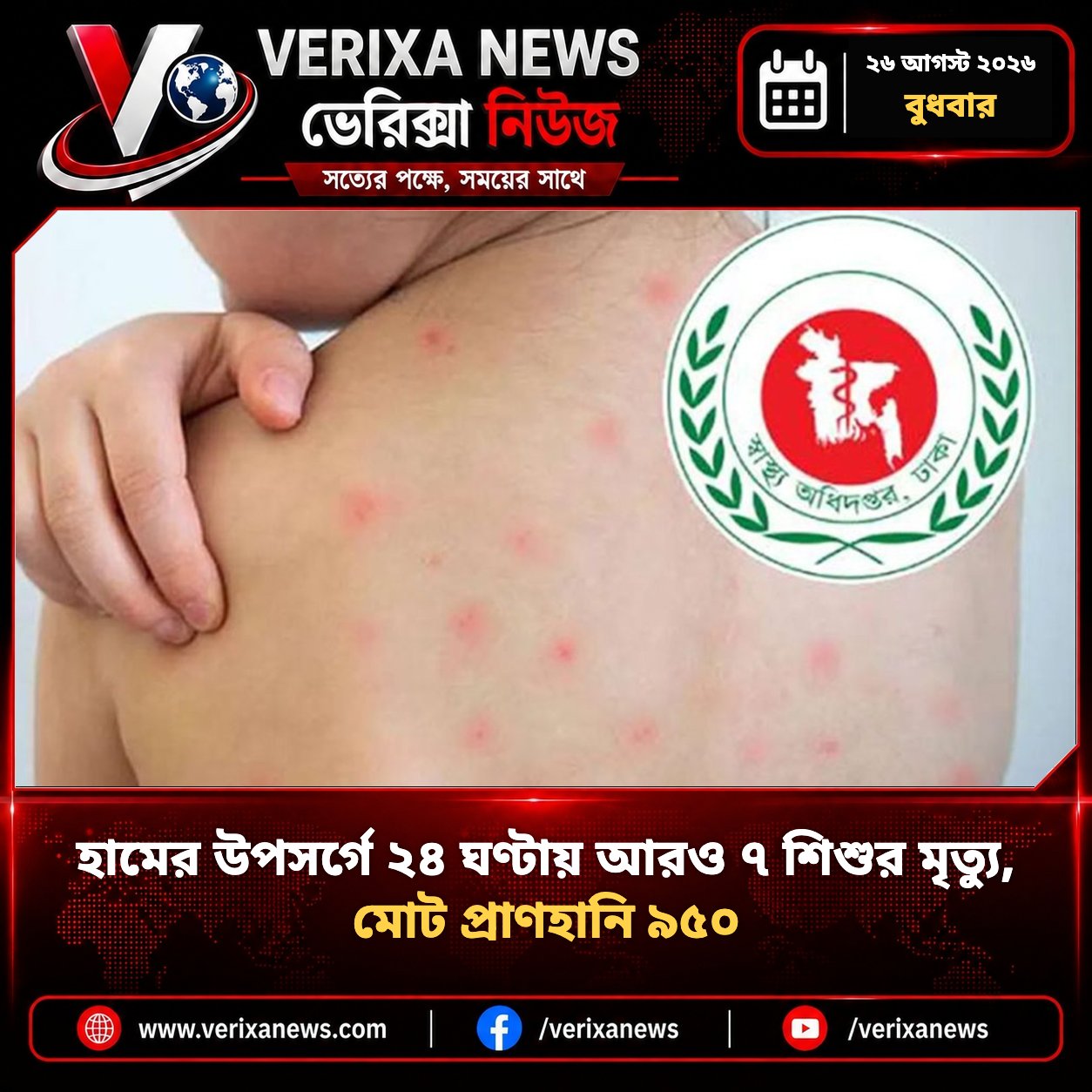 হামের উপসর্গে ২৪ ঘণ্টায় আরও ৭ শিশুর মৃত্যু, মোট প্রাণহানি ৯৫০